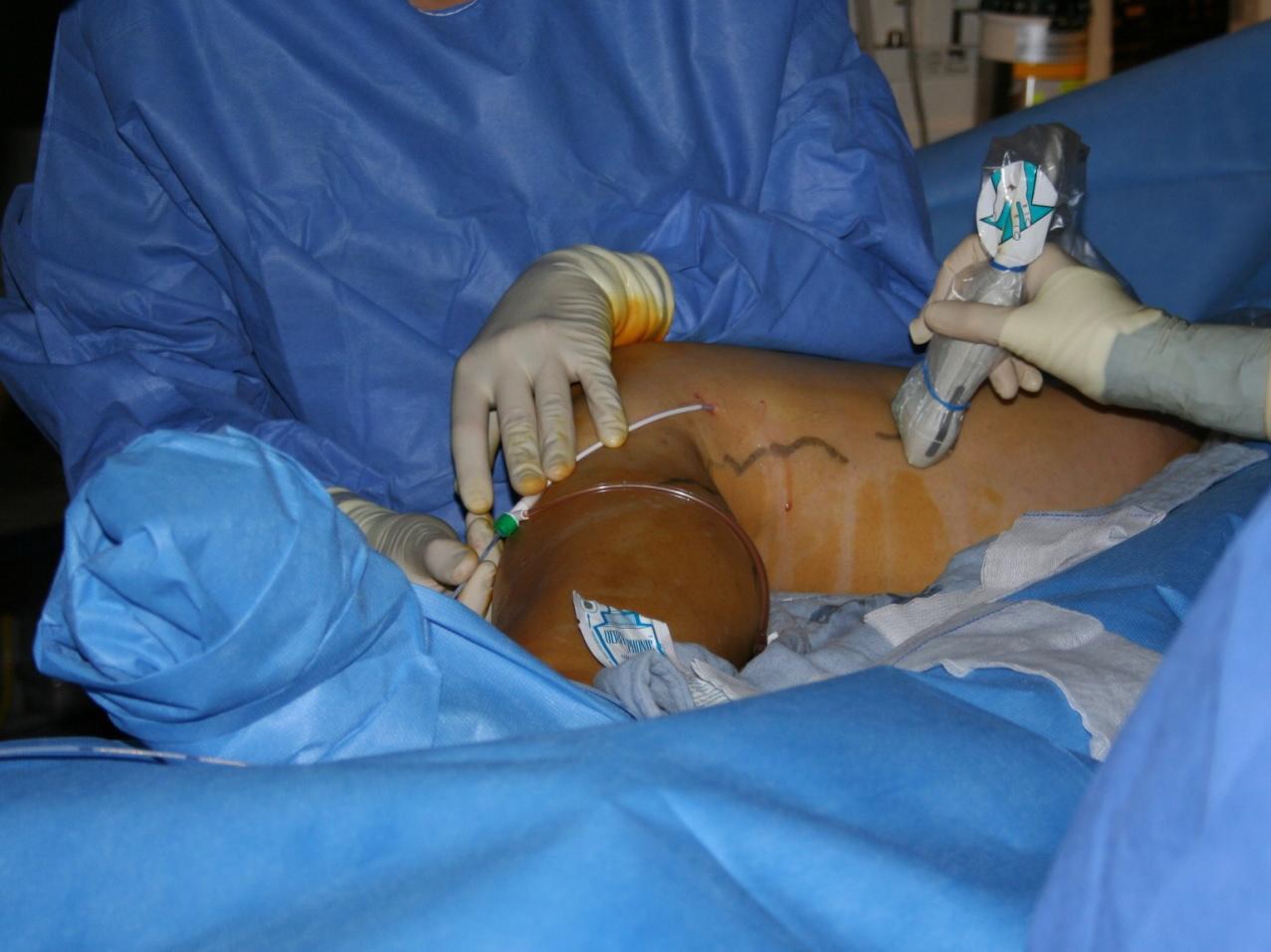 Operation bei einem Venenverschluss