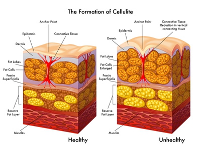 Haut im Vergleich, mit und ohne Cellulite