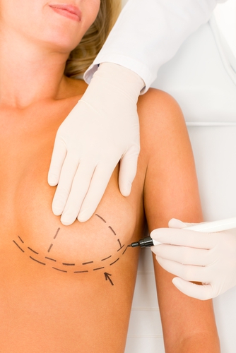 Frau mit Markierungen an der Brust vor der Operation
