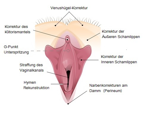Intimchirurgie Eingriffe und Methoden