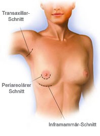 3 Schnittmöglichkeiten bei der Brustvergrößerung