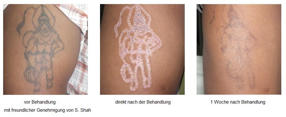 3 Phasen: 1. Tattoo vor Behandlung, 2. Tattoo direkt nach Behandlung, 3. Tattoo eine Woche nach der Entfernung