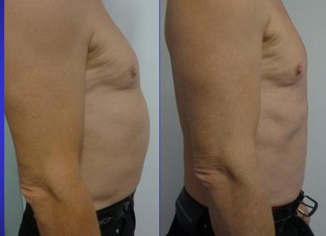Patient vor und nach der Kryolipolyse
