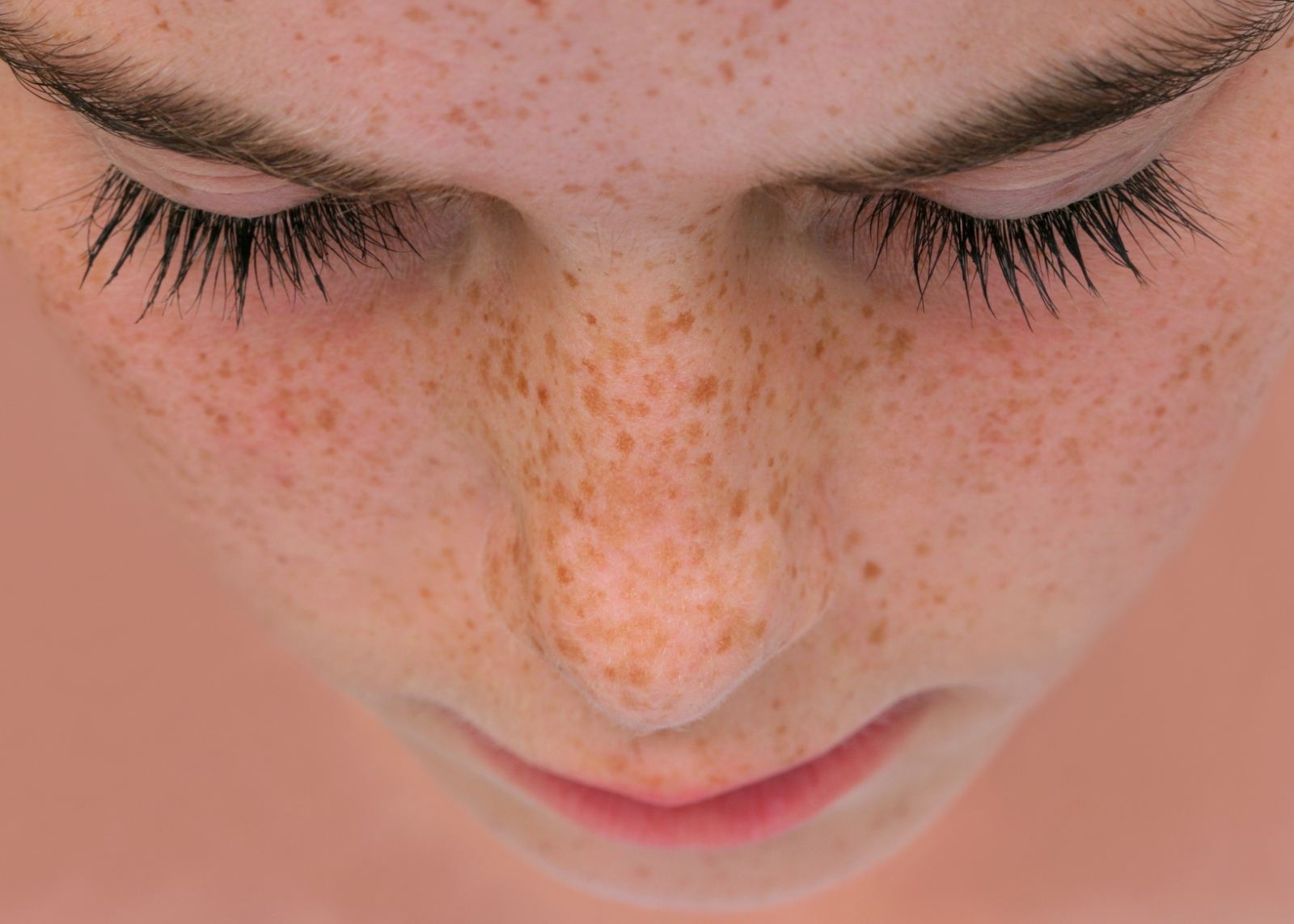 Sommersprossen sind eine der häufigsten Formen von Pigmentflecken im Gesicht